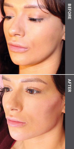 Treatments: Jawline Enhancement - Heart Aesthetics